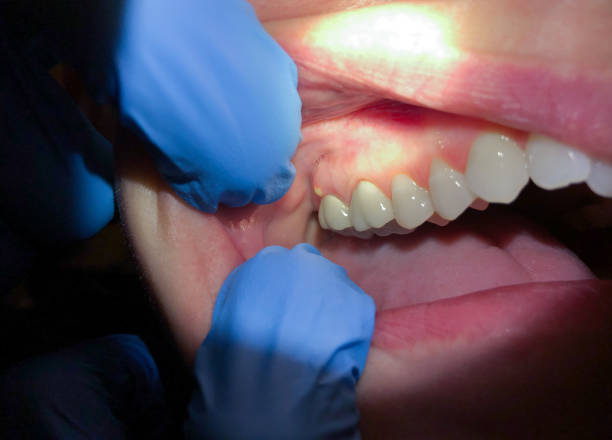 Best Emergency Gum Treatment in West Pensacola, FL